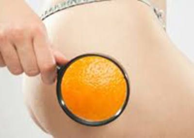 Culotte de cheval, Peau d'orange, cellulite